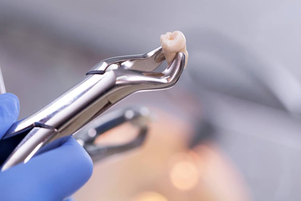 why tooth extraction is necessary